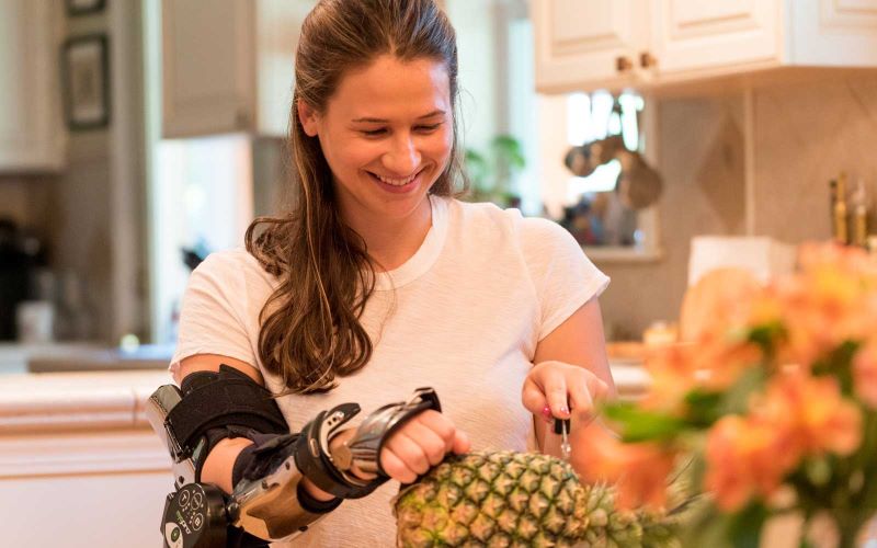 Woman cutting pineapple in myopro orthosis